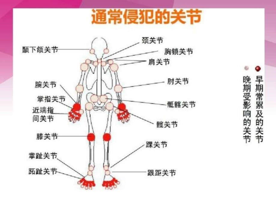 类风湿性关节炎的X线诊断知识PPT课件_第5页