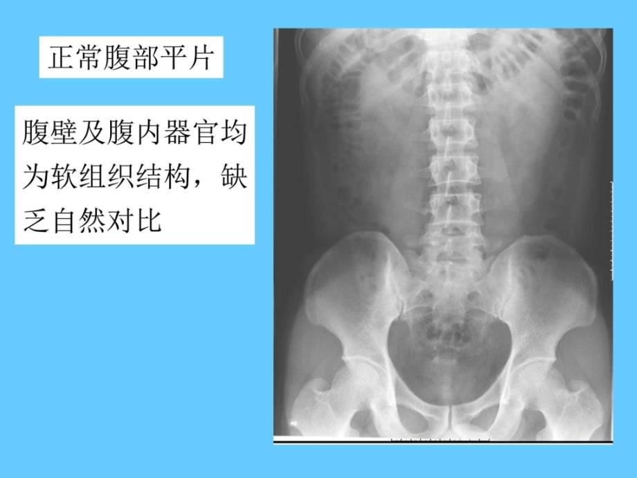 肠梗阻的X线表现知识PPT课件_第3页