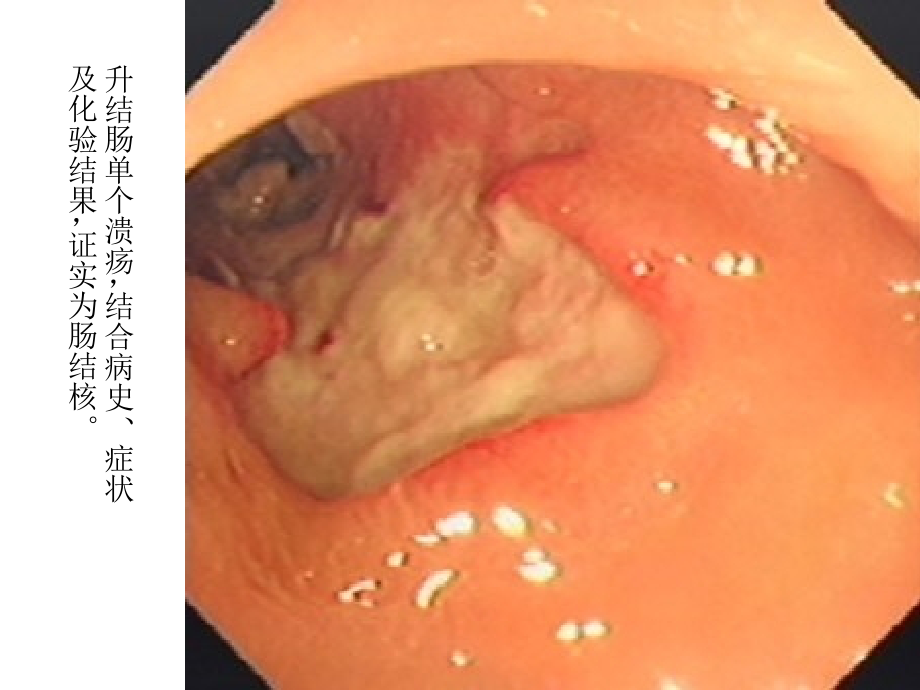 肠、腹膜结核知识PPT课件_第3页