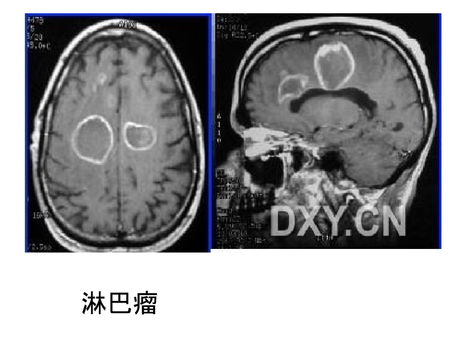 总结环状强化的颅内疾病知识PPT课件_第2页