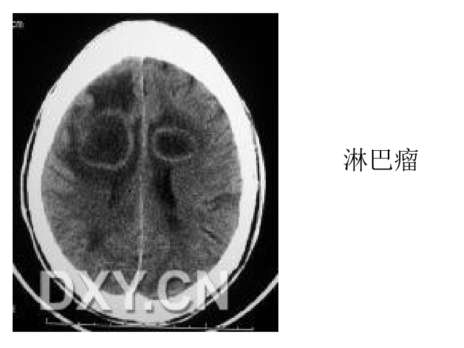 总结环状强化的颅内疾病知识PPT课件_第3页