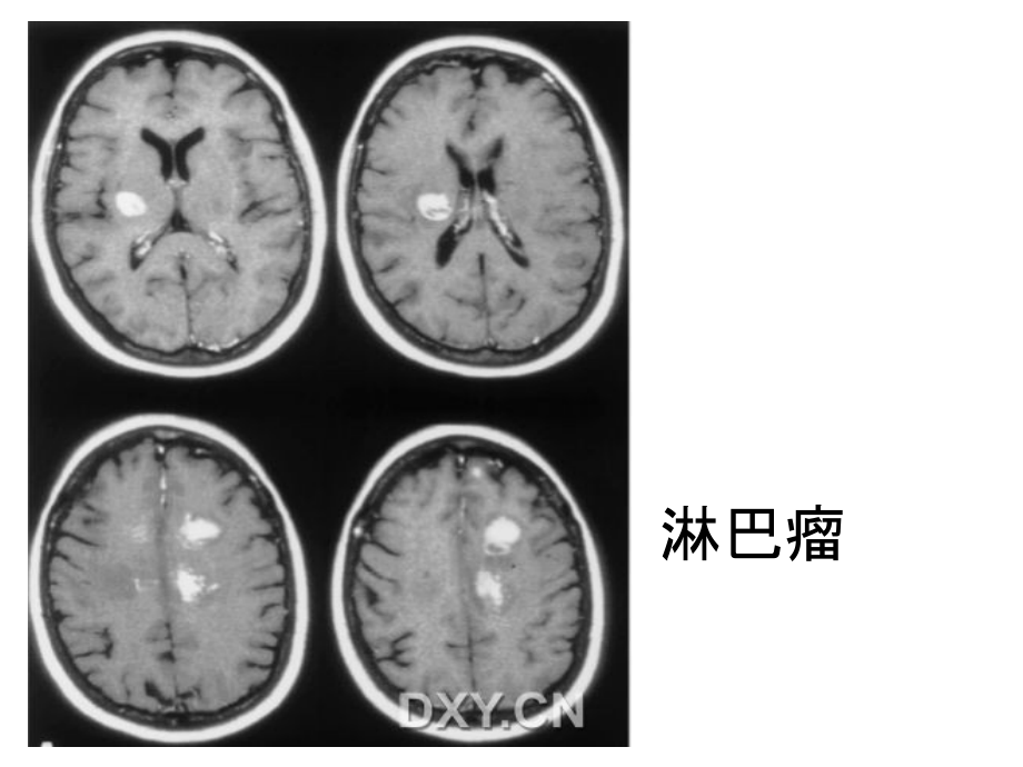 总结环状强化的颅内疾病知识PPT课件_第4页