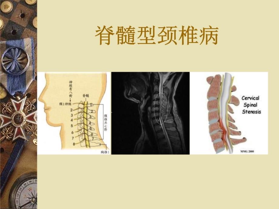 脊髓型颈椎病培训课件_第3页