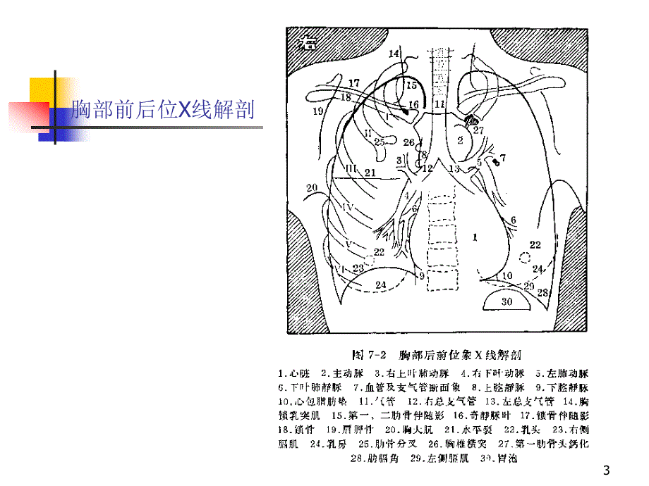 正常胸片胸部CT阅读浅谈PPT课件.ppt_第3页