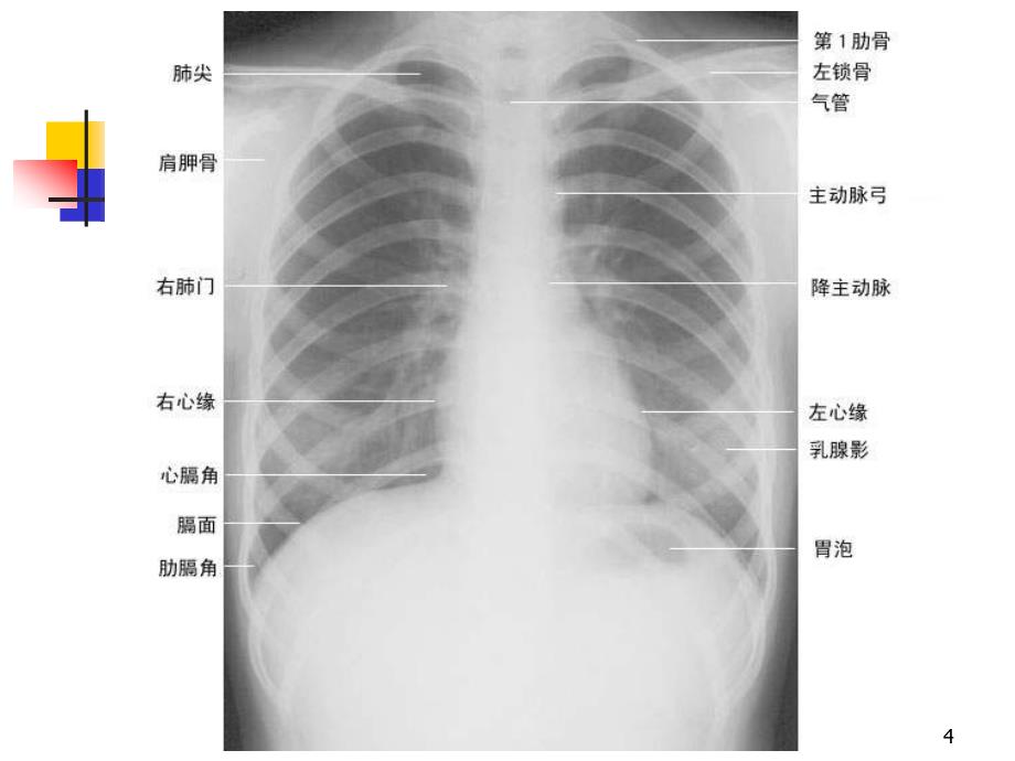 正常胸片胸部CT阅读浅谈PPT课件.ppt_第4页