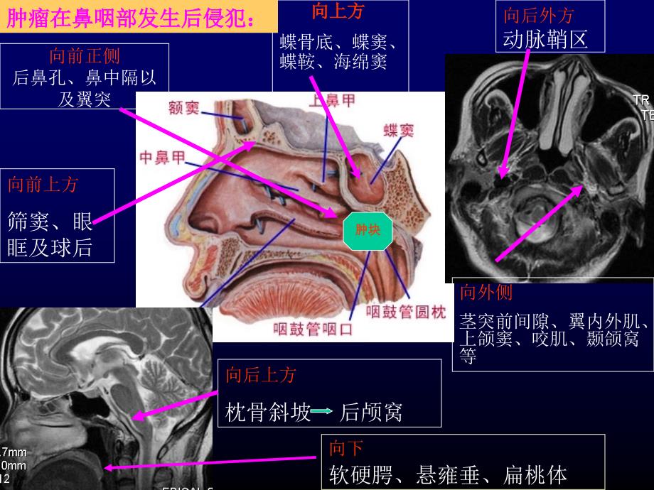 鼻咽癌的影像学诊断知识PPT课件_第2页