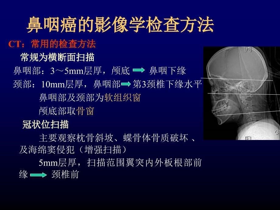 鼻咽癌的影像学诊断知识PPT课件_第5页