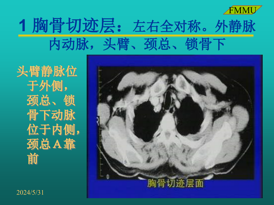 胸部CT读片知识PPT课件_第4页