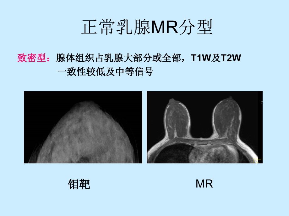 乳腺MRI诊断完整版本.ppt_第4页