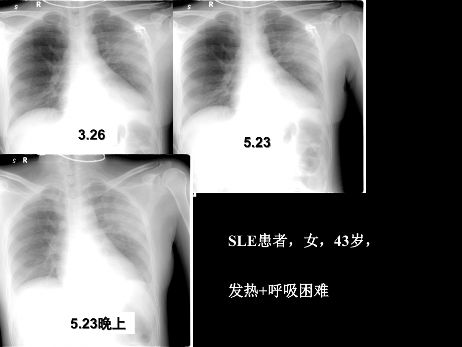 肺部感染与抗生素应用[完整版本].ppt_第2页