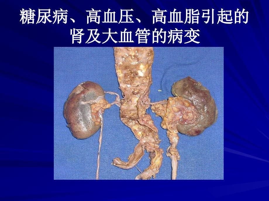 糖尿病健康教育知识PPT课件_第5页