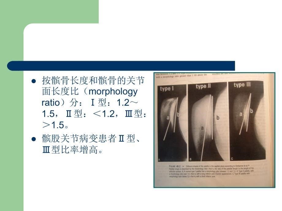 髌股关节紊乱 (NXPowerLite).ppt_第5页