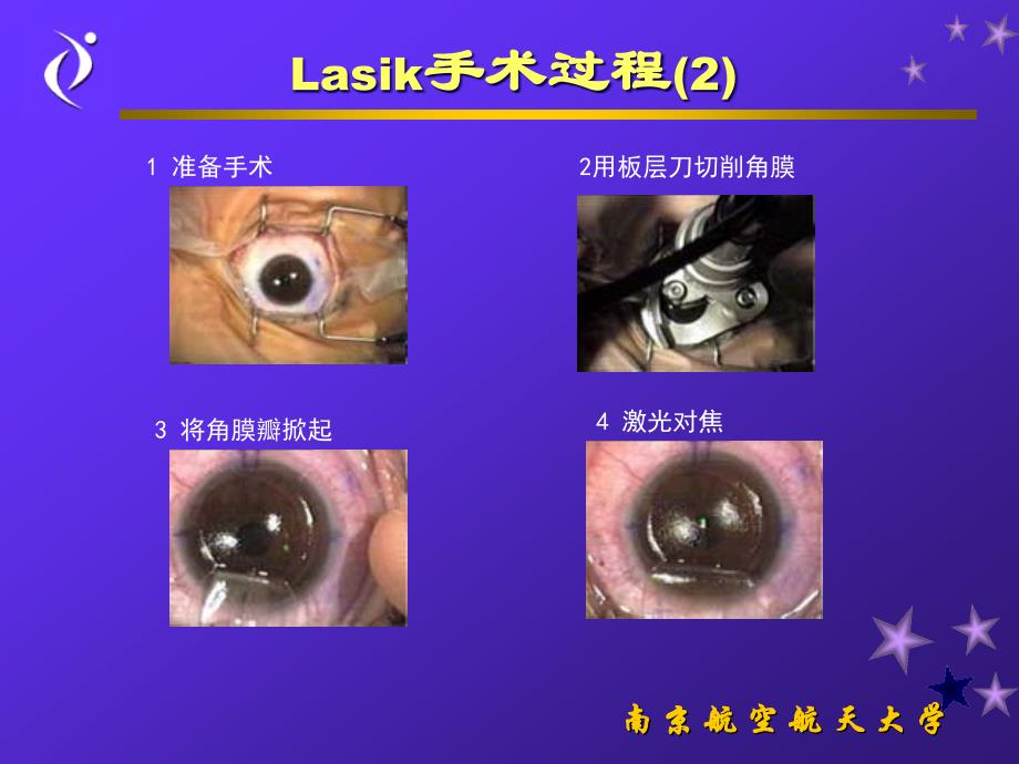 准分子激光矫正眼屈光不正及视觉像差技术PPT课件.ppt_第3页