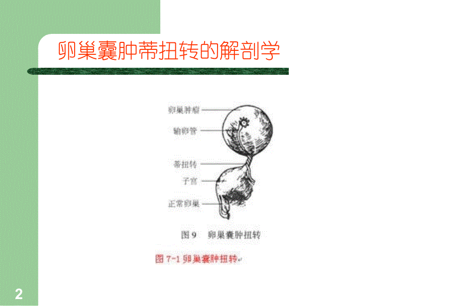 卵巢囊肿蒂扭转PPT课件.ppt_第2页