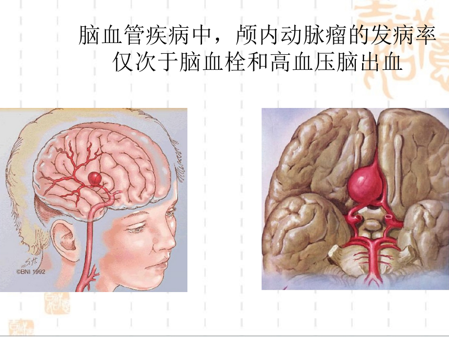 脑动脉瘤手术配合上课讲义_第2页
