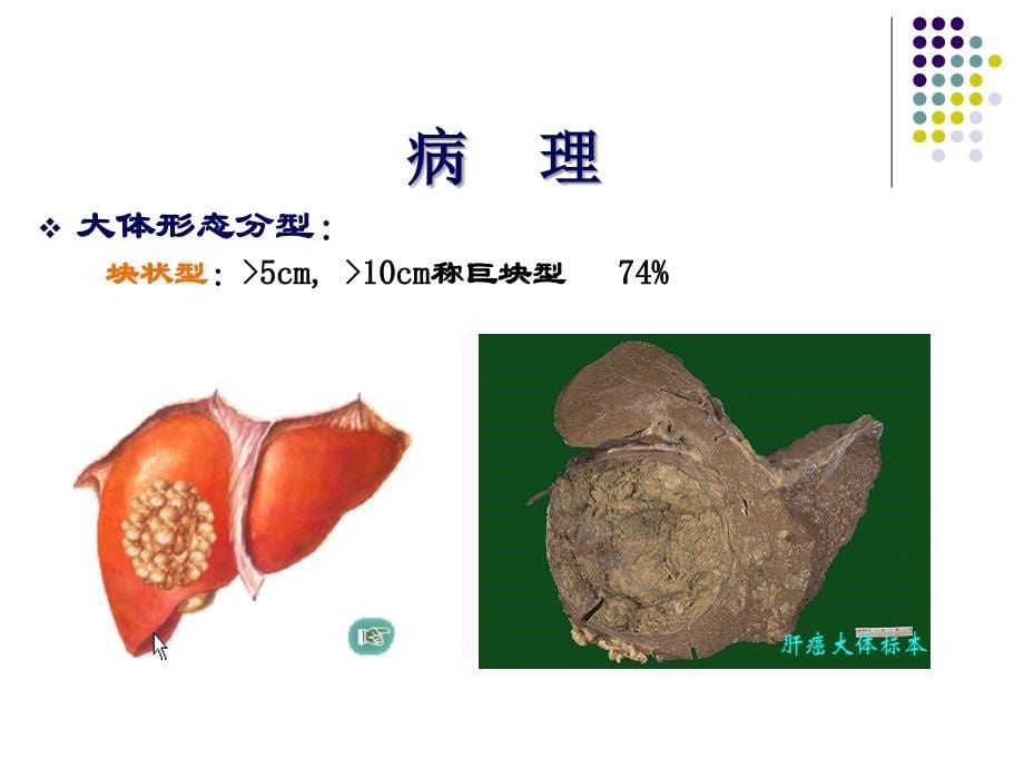 原发性肝癌_课件_第5页