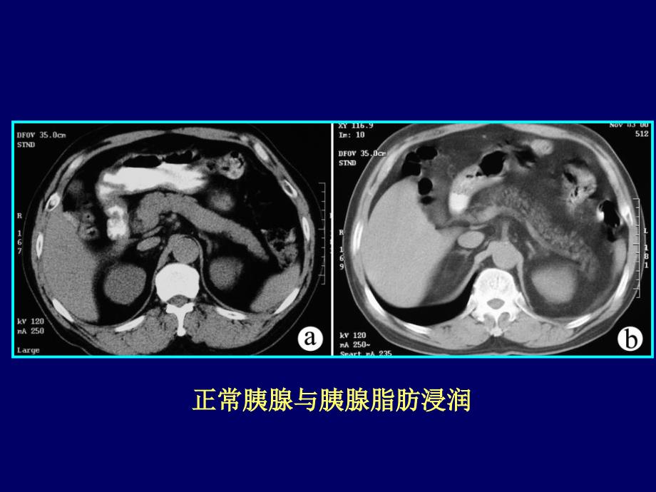 胰腺常见病变的CT诊断知识PPT课件_第3页