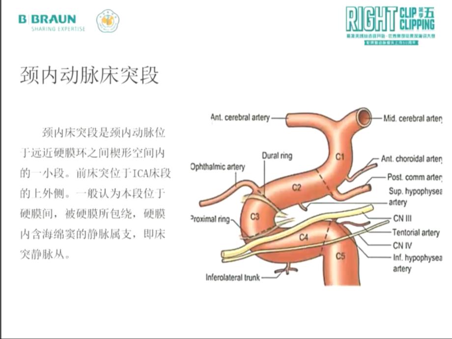 前床突巨大动脉瘤手术夹闭.ppt_第3页