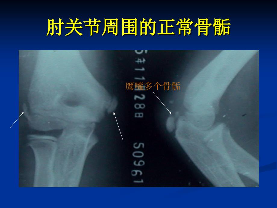 肱骨外髁骨折PPT课件_第2页