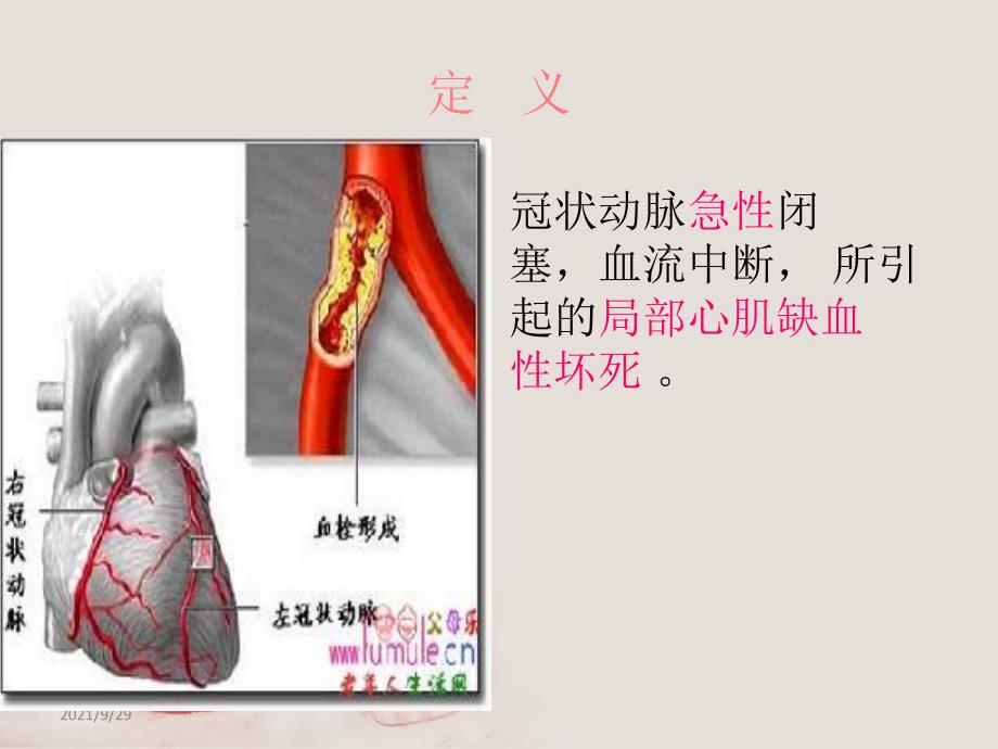 急性心肌梗死的护理查房PPT课件_第3页