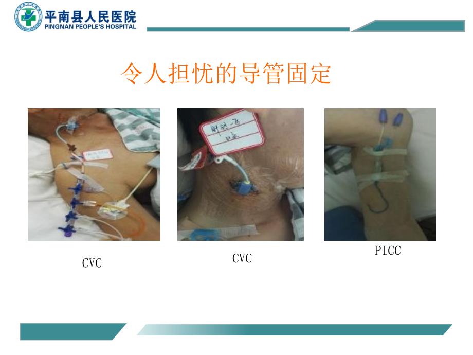 静疗培训常见各种导管的固定方法参考课件_第4页