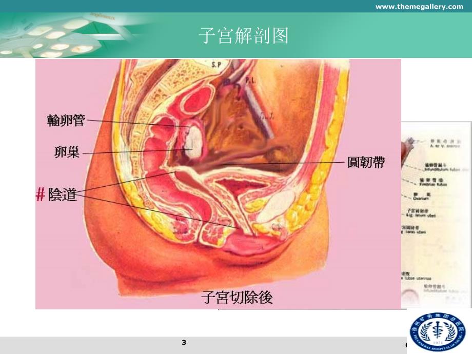 子宫全切术手术步骤参考_第3页