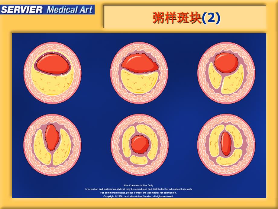 动脉粥样硬化精美图片参考_第3页