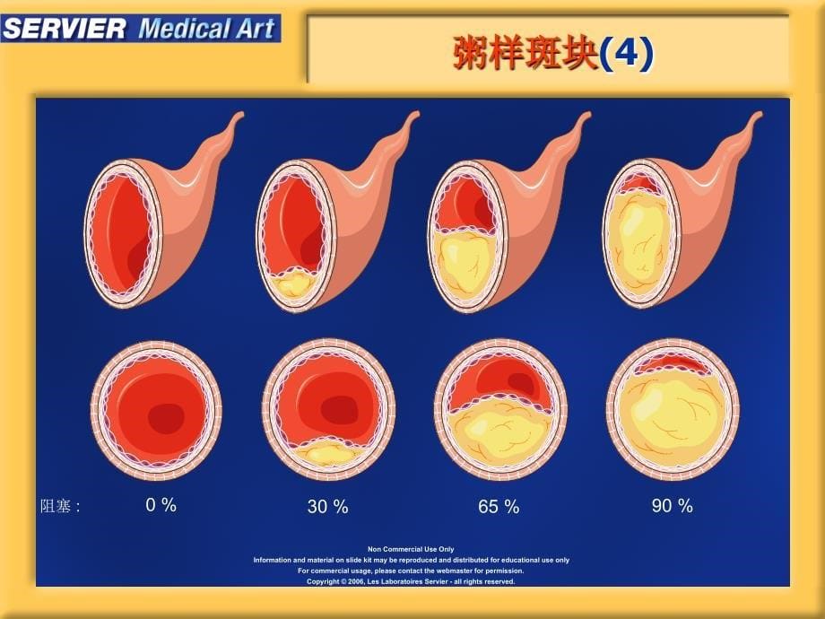 动脉粥样硬化精美图片参考_第5页