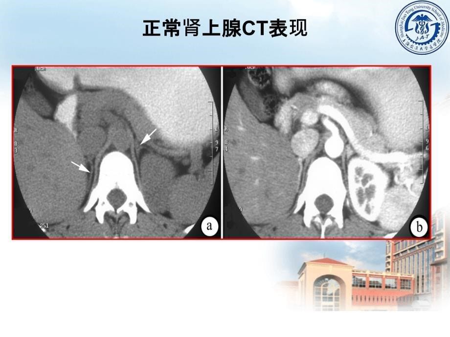 肾上腺疾病课件2015知识讲解_第5页