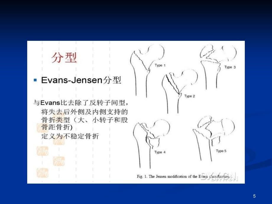 股骨粗隆间骨折内固定的选择及治疗策略参考课件_第5页