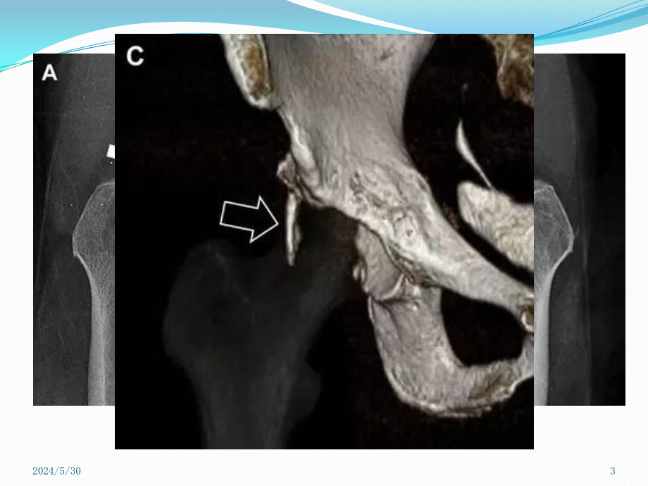 放射科医生千万不要漏诊的36种骨折PPT参考幻灯片_第3页