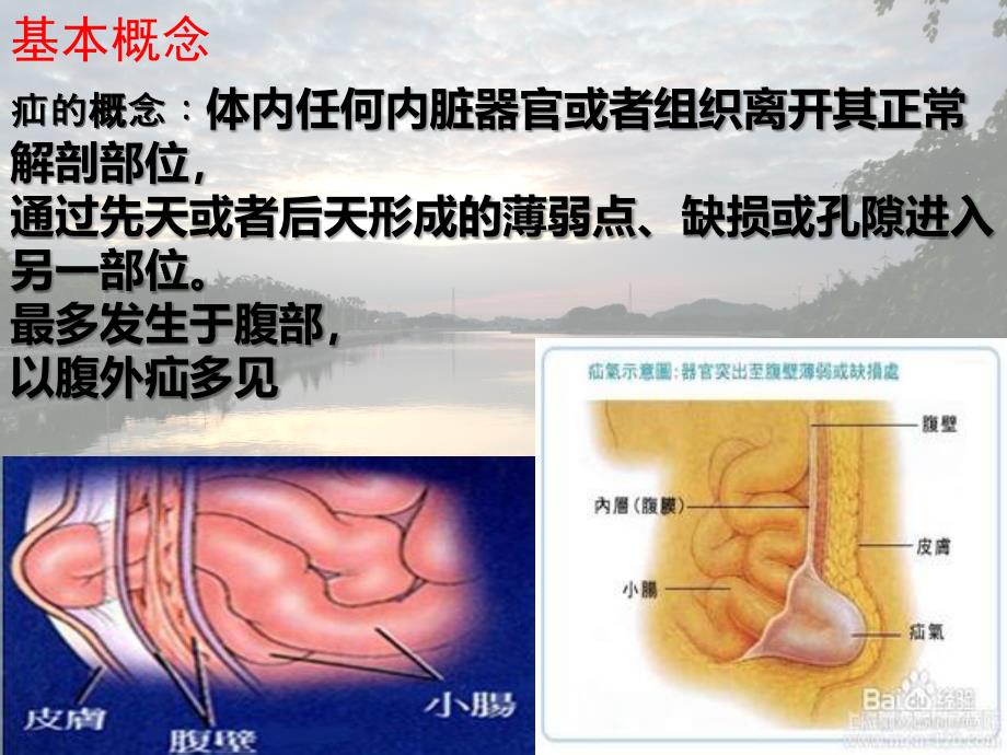 腹股沟疝患者的护理医学课件_第2页