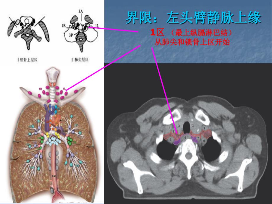 肺部淋巴结分组ppt课件_第4页