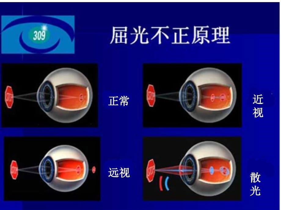 近视专题知识讲座医学课件_第5页