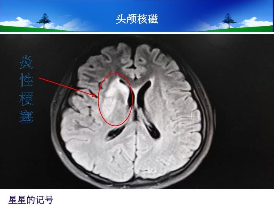 结核性脑膜炎护理查房医学课件_第5页