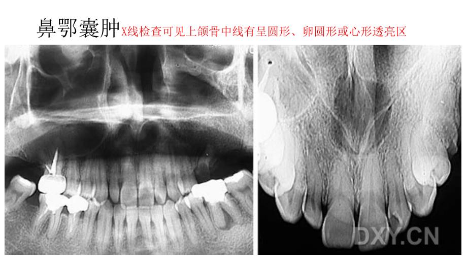 常见的口腔病例影像医学课件_第4页