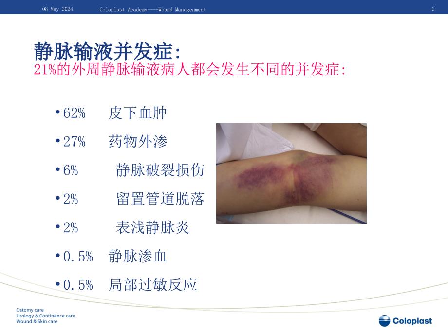 静脉炎的预防和处理医学课件_第2页