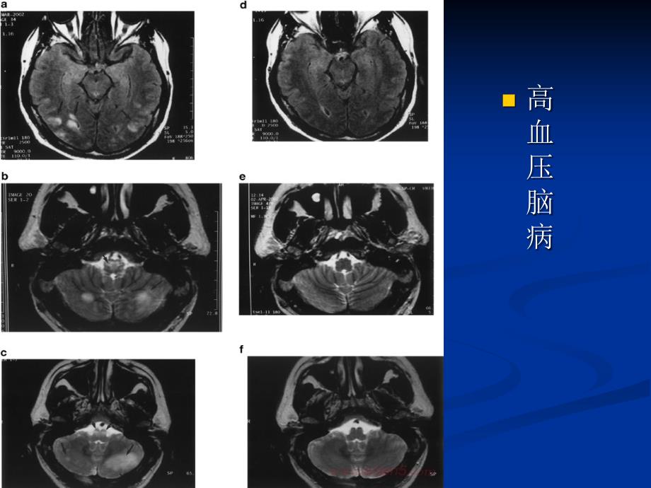 高血压脑病医学课件_第3页