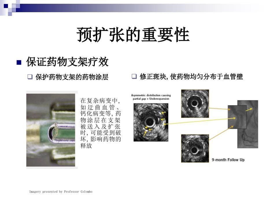 球囊在冠脉介入治疗中的作用医学课件_第5页