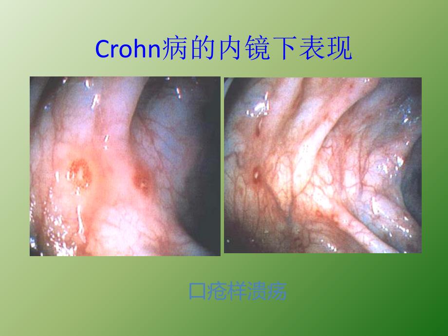 克罗恩病ppt医学课件_第4页