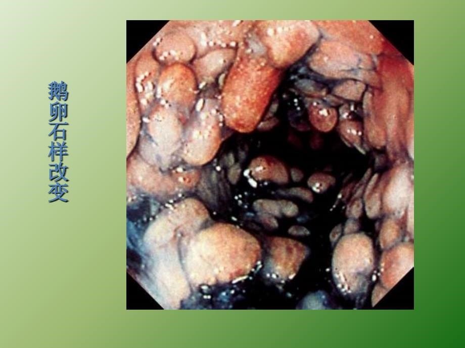 克罗恩病ppt医学课件_第5页