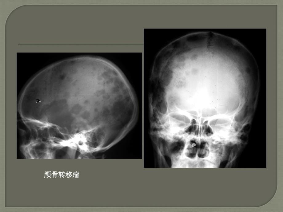 手把手教你读懂颅脑 C Tppt医学课件_第5页