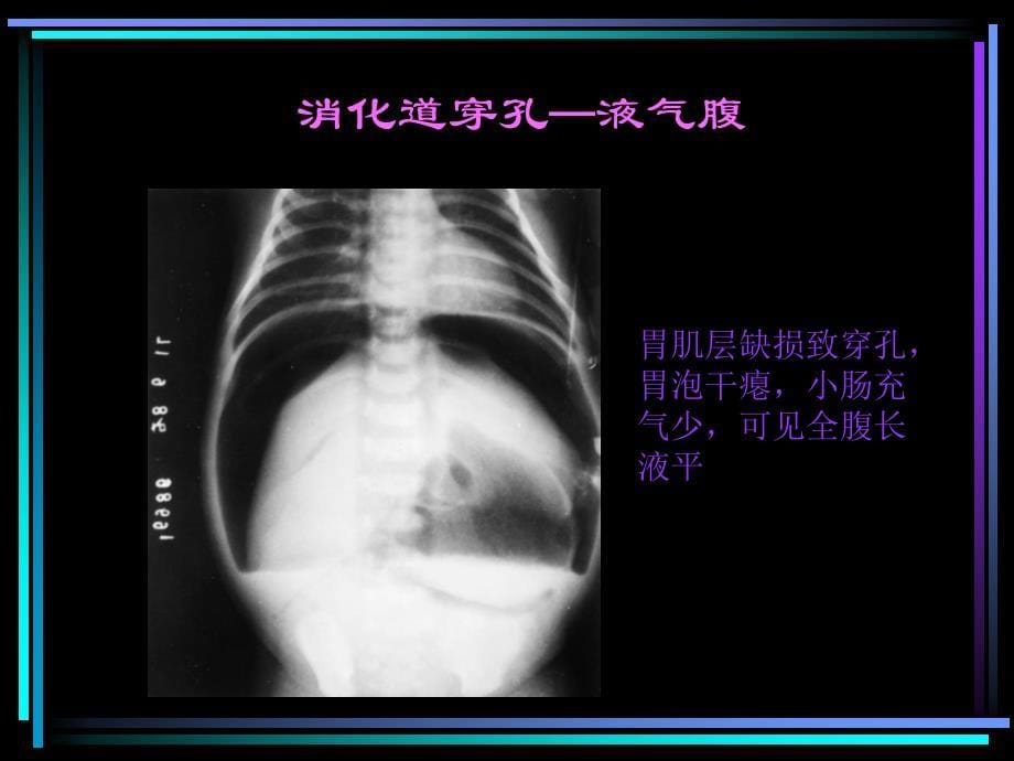 小儿腹部急症的影像诊断ppt课件_第5页