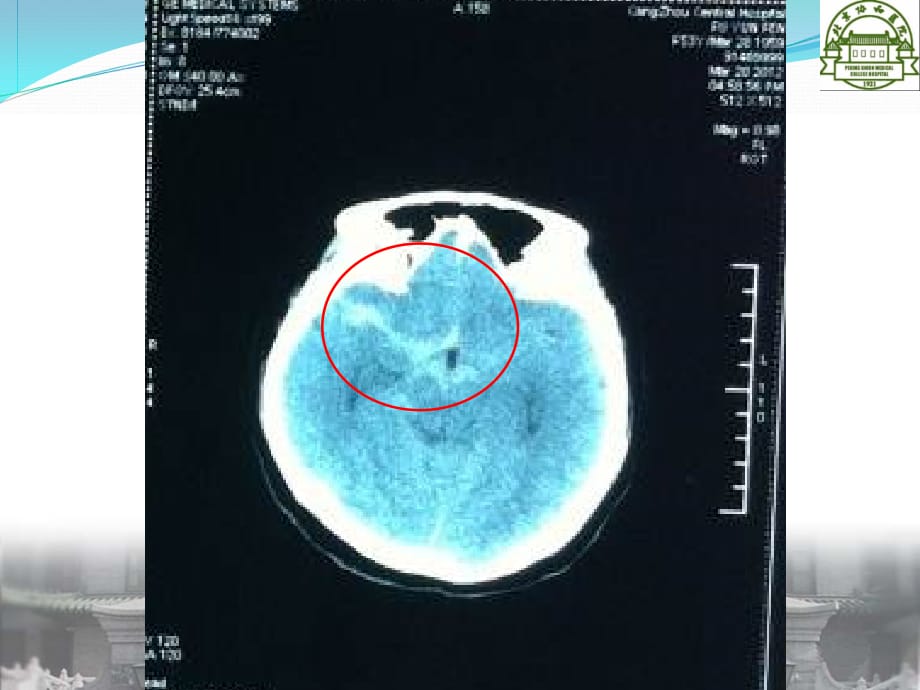 蛛网膜下腔出血病例讨论医学课件_第4页