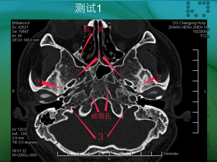 颅骨外伤性骨折 C T诊断ppt医学课件_第2页