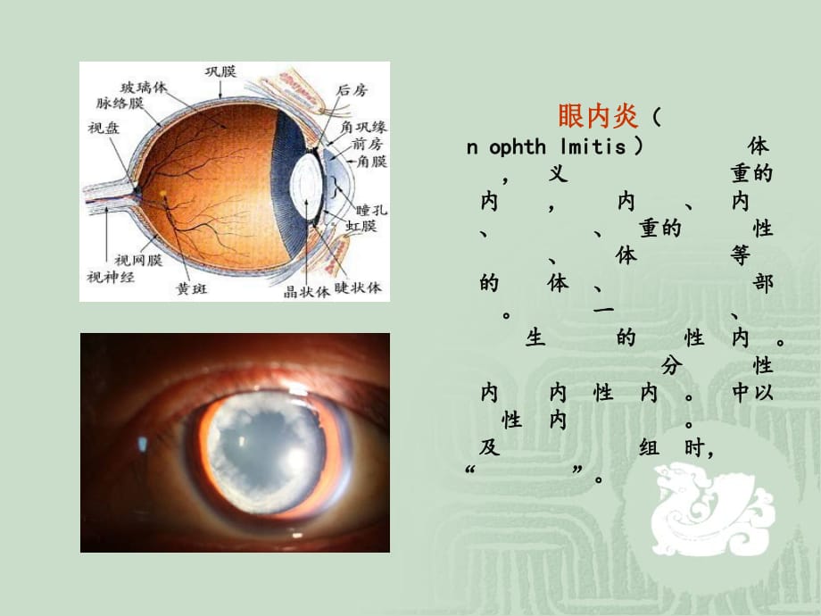 眼内炎患者的护理查房医学课件_第2页