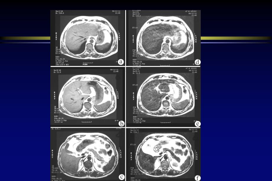 第四章 腹盆部影像解剖MRppt课件_第3页