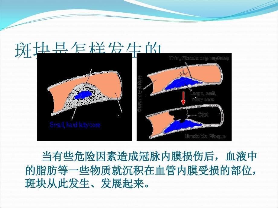 冠心病护理要点ppt医学课件_第5页