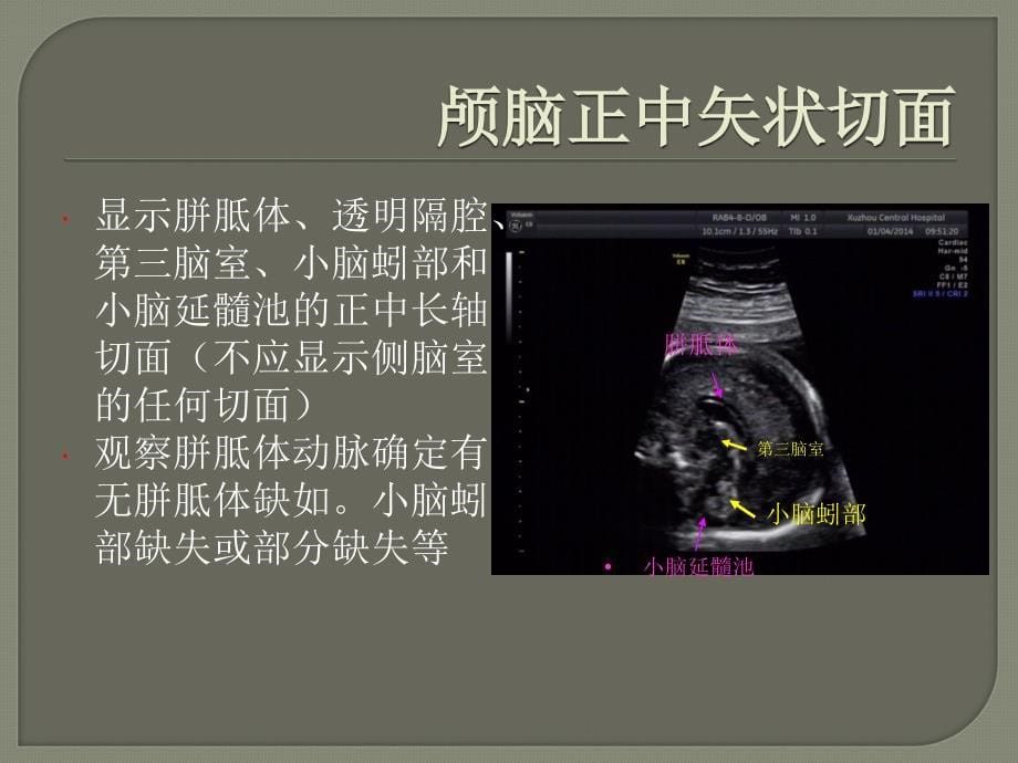 胎儿三维超声筛查标准切面ppt医学课件_第5页