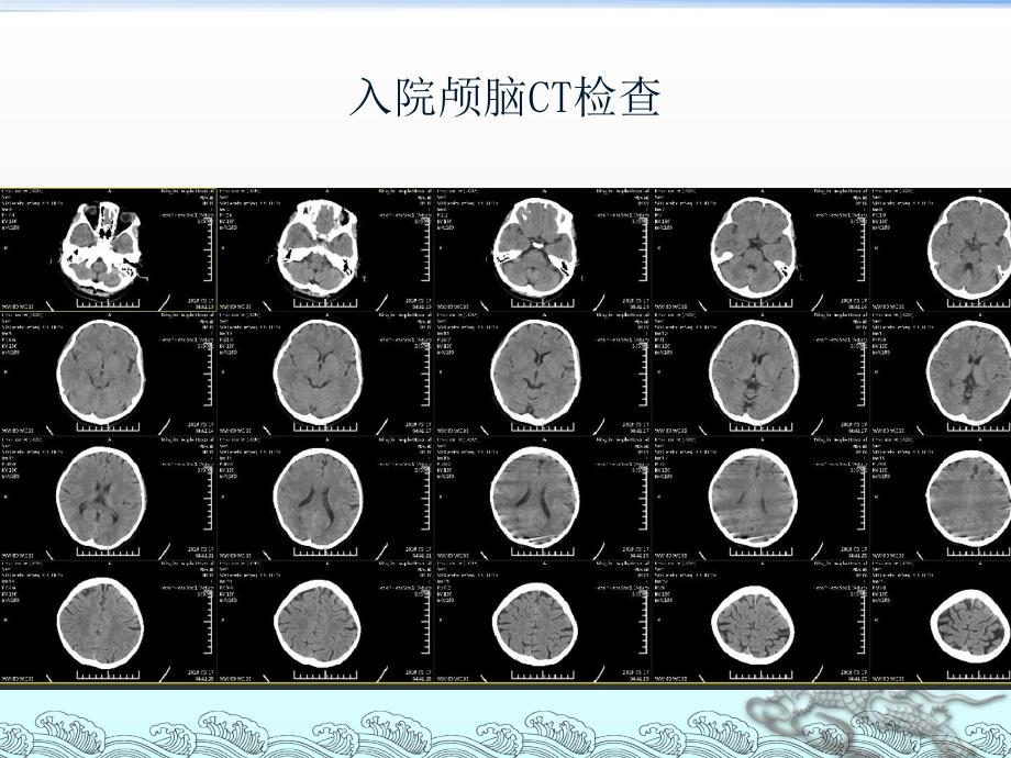 急性脑梗死动脉取栓治疗ppt医学课件_第3页